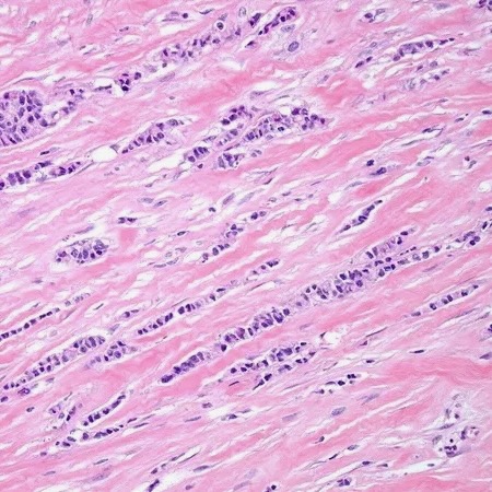 Cancer tissue histology slide showing cellular structure for pathological analysis